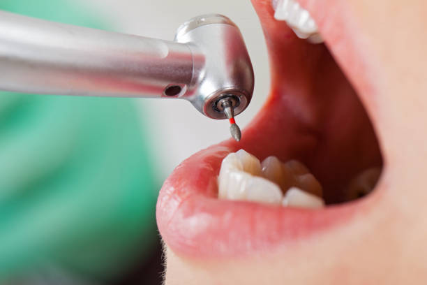 Best Dentist for Tooth Abscess  in Chester, IL